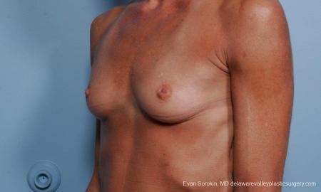 Philadelphia Breast Augmentation 8656 - Before and After Image 3