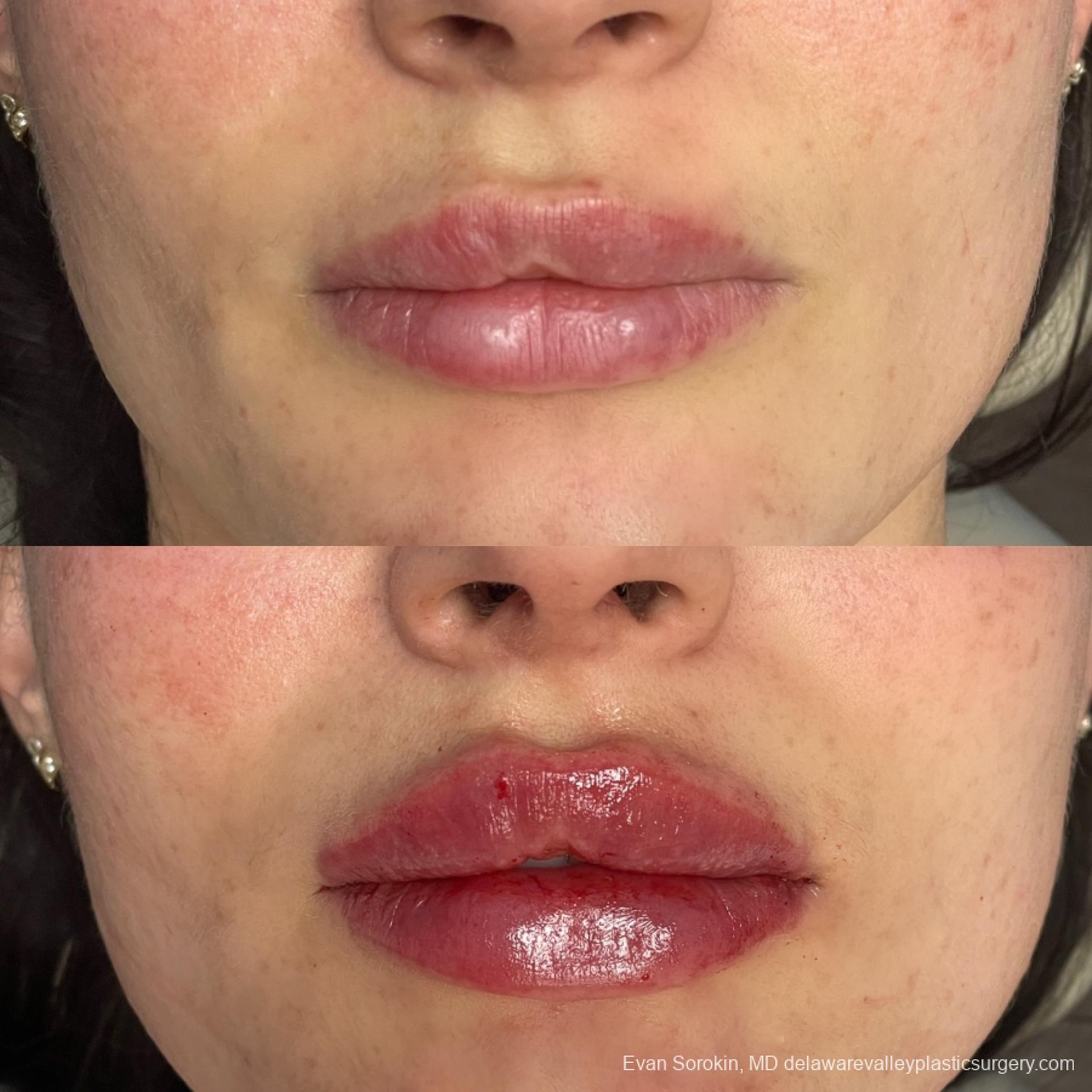 Lip Filler: Patient 63 - Before and After 1