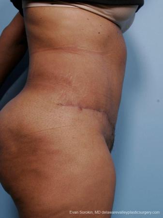Philadelphia Abdominoplasty 9461 - After Image 3