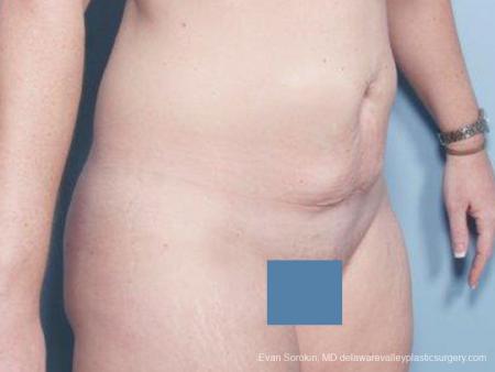 Philadelphia Abdominoplasty 9476 - Before Image 2