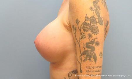 Philadelphia Breast Augmentation 9371 - After Image 5