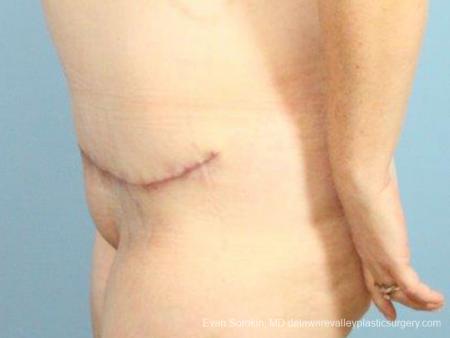 Philadelphia Abdominoplasty 9467 - After Image 5