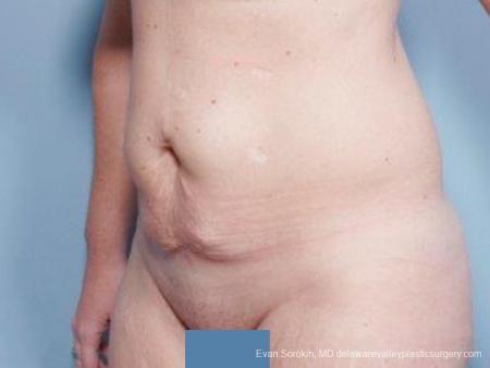 Philadelphia Abdominoplasty 9476 - Before Image 4