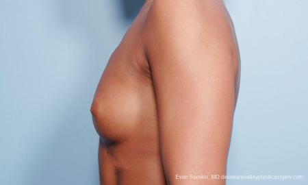 Philadelphia Breast Augmentation 9299 - Before and After Image 3