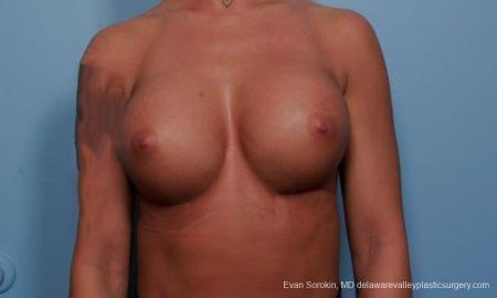 Philadelphia Breast Augmentation 9299 - After Image 1