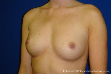 Philadelphia Breast Augmentation 8670 - Before Image 3