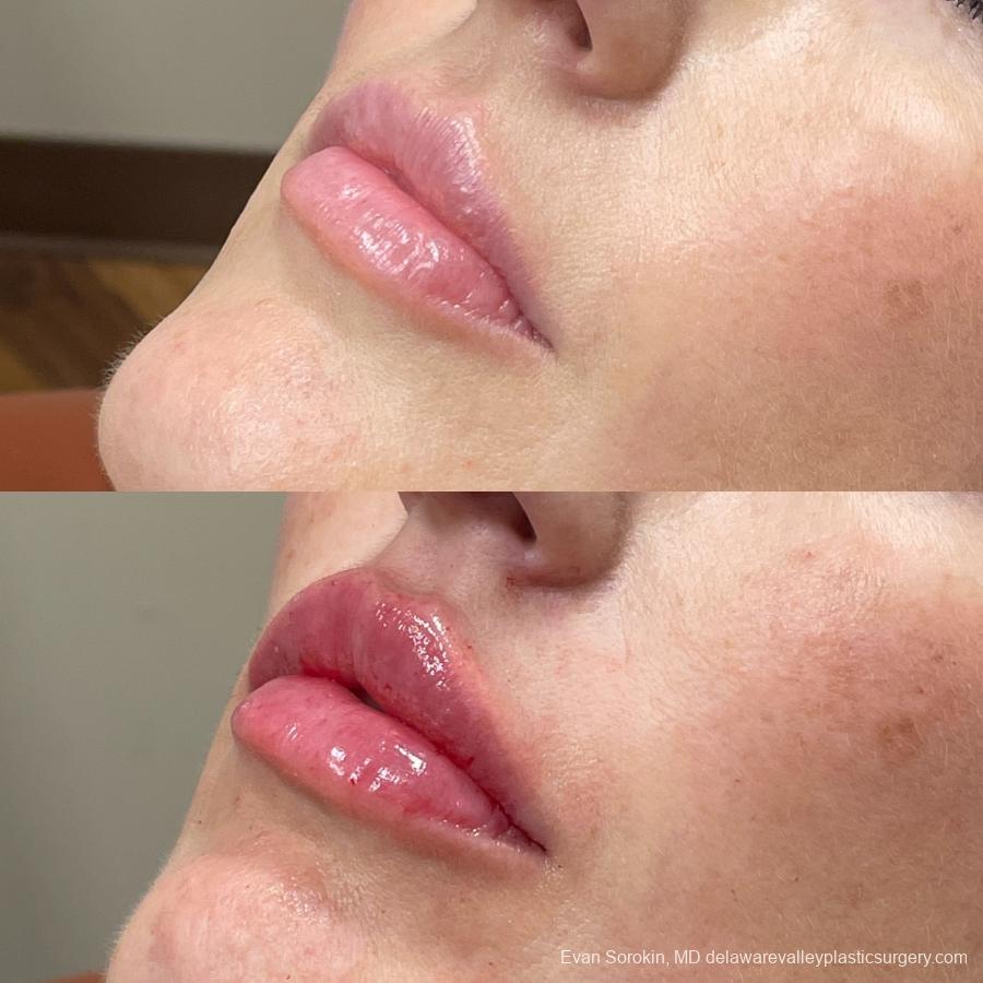 Lip Filler: Patient 2 - Before and After 3