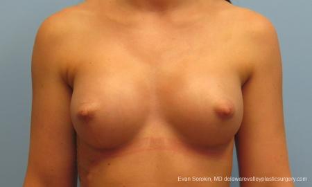 Philadelphia Breast Augmentation 8664 - After Image 1