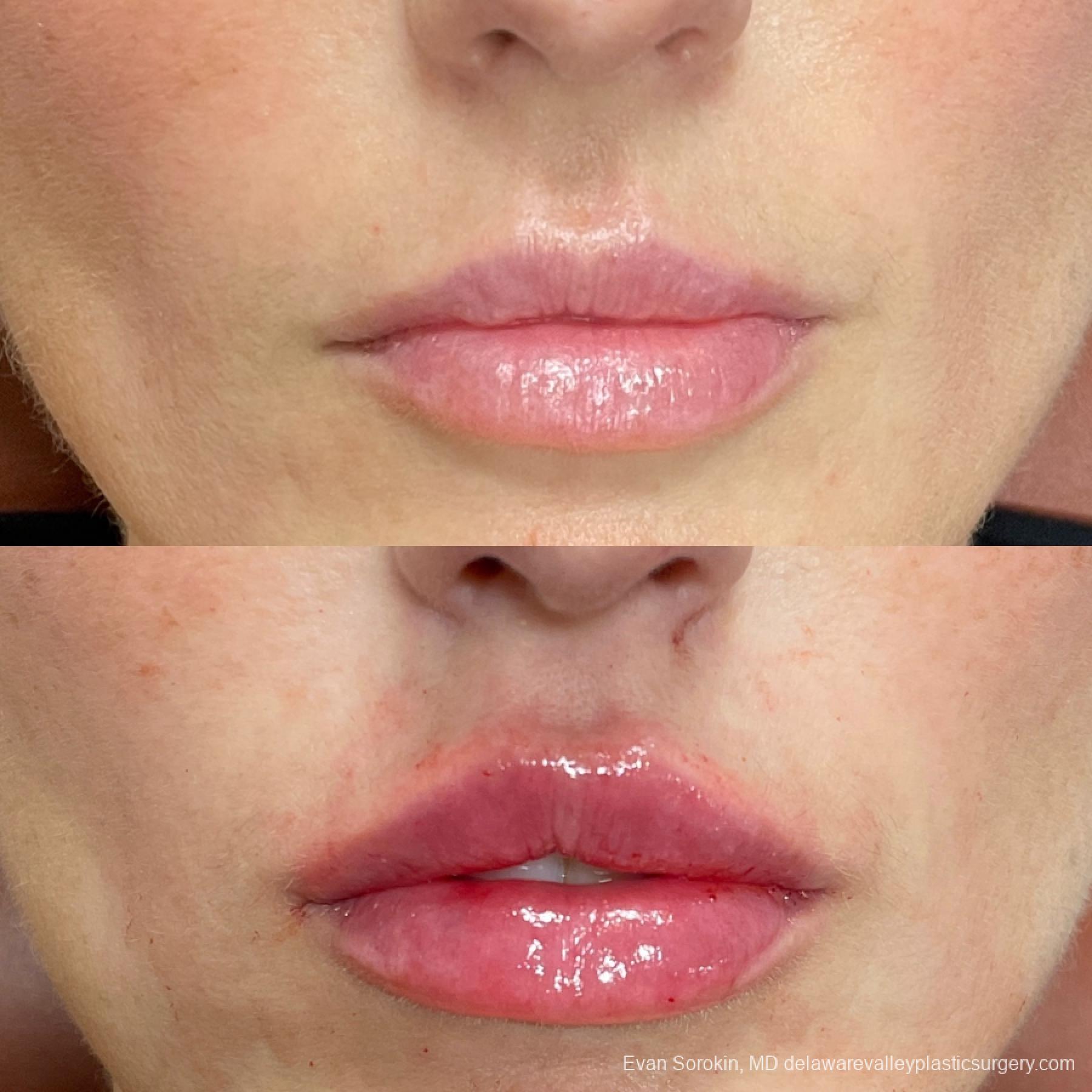 Fillers: Patient 30 - Before and After 1