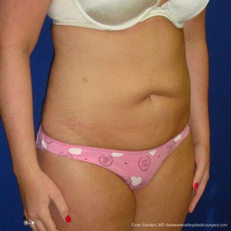 Philadelphia Liposuction 9484 - After Image 2