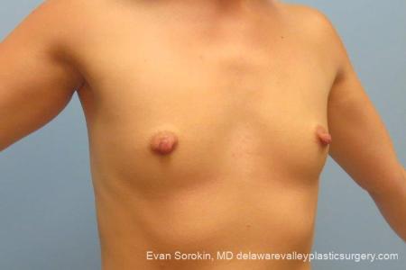Philadelphia Breast Augmentation 10193 - Before Image 2