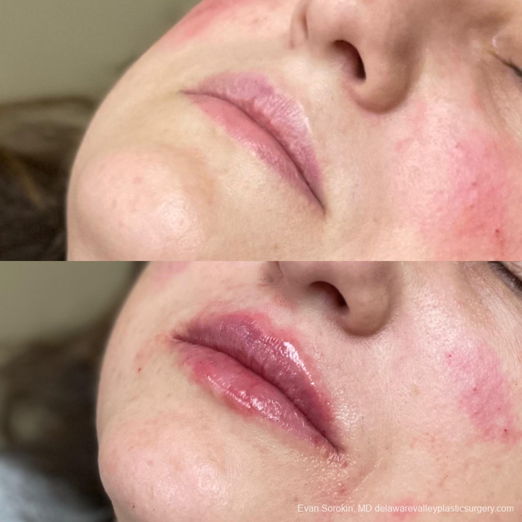 Lip Augmentation: Patient 8 - Before and After 3