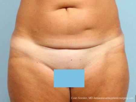 Philadelphia Abdominoplasty 9464 - Before Image 1