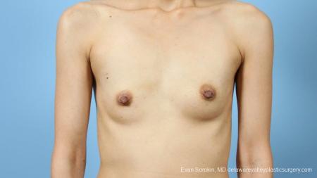 Philadelphia Breast Augmentation 9291 - Before Image 1