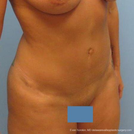 Philadelphia Abdominoplasty 9475 - After Image 2