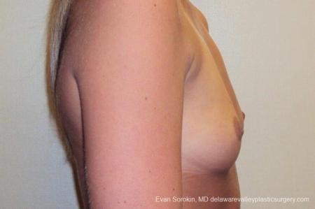 Philadelphia Breast Augmentation 8772 - Before Image 4