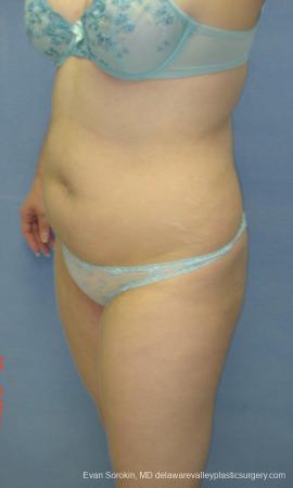Philadelphia Liposuction 9480 - Before Image 2