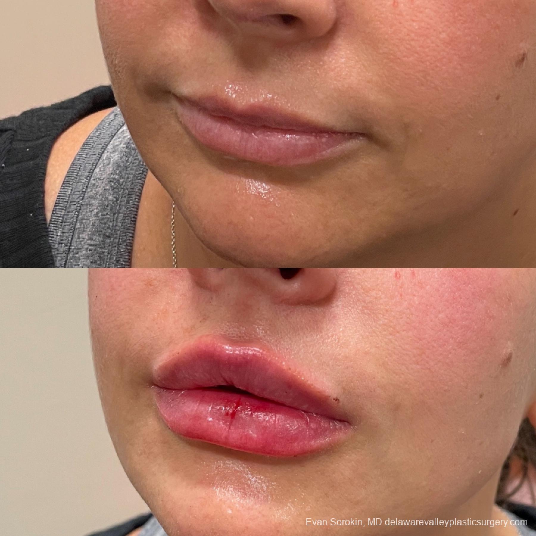 Lip Augmentation: Patient 25 - Before and After 3
