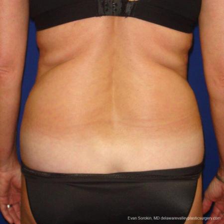 Philadelphia Liposuction 9488 - Before and After Image 5