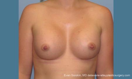 Philadelphia Breast Augmentation 10193 - After Image 1