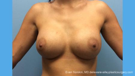 Breast Augmentation: Patient 137 - After Image 1