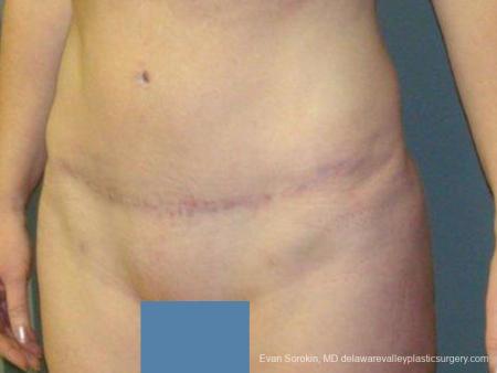 Philadelphia Abdominoplasty 9474 - After Image 4