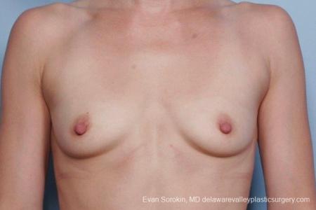 Philadelphia Breast Augmentation 8767 - Before Image 1