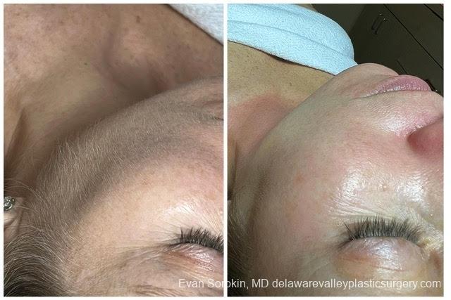 Dermaplaning: Patient 1 - Before and After 1
