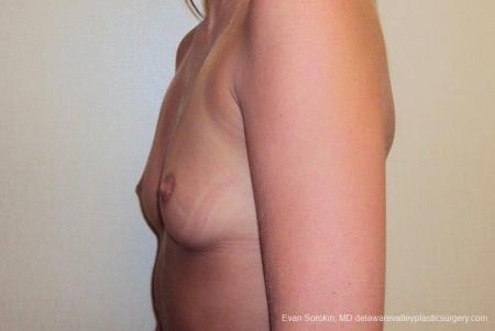 Philadelphia Breast Augmentation 8772 - Before and After Image 5