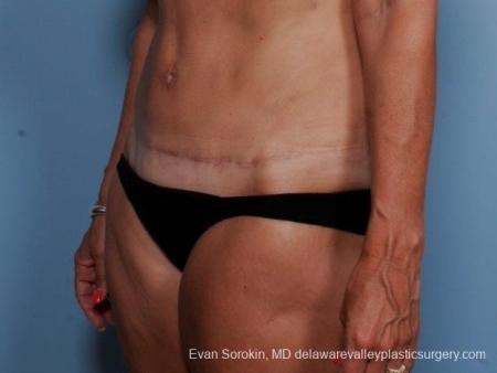 Philadelphia Abdominoplasty 8682 - After Image 3