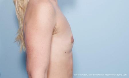 Philadelphia Breast Augmentation 8651 - Before Image 4