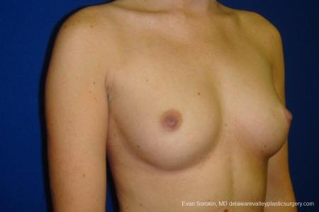 Philadelphia Breast Augmentation 8670 - Before Image 2