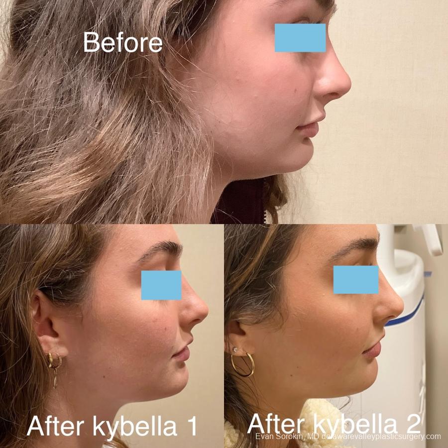 Fillers: Patient 43 - Before and After 2