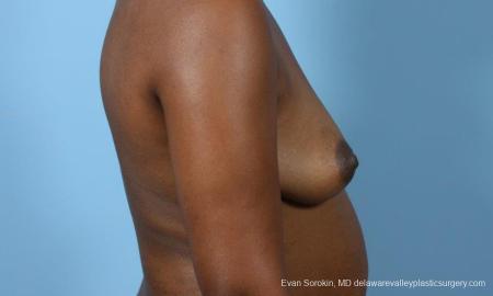 Philadelphia Breast Augmentation 9173 - Before Image 3