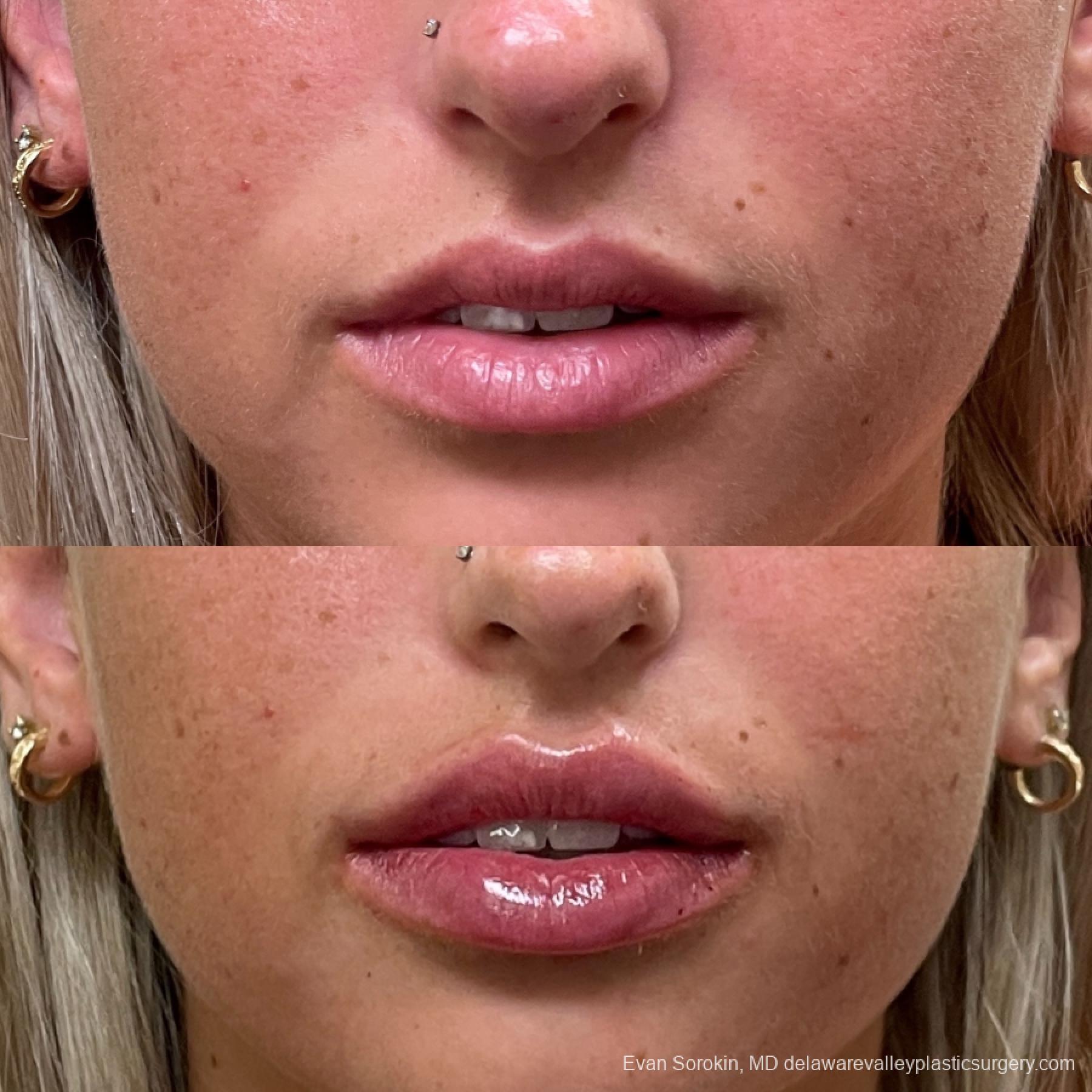 Lip Filler: Patient 27 - Before and After 1