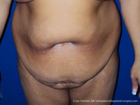 Philadelphia Abdominoplasty 9471 - Before Image 1