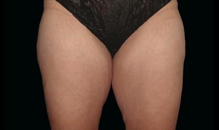 CoolSculpting®: Patient 12 - Before Image 1