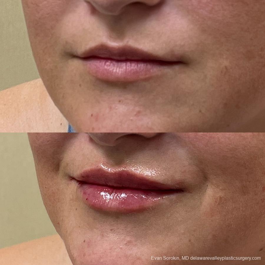 Lip Filler: Patient 12 - Before and After 3