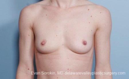 Philadelphia Breast Augmentation 9107 - Before Image 1