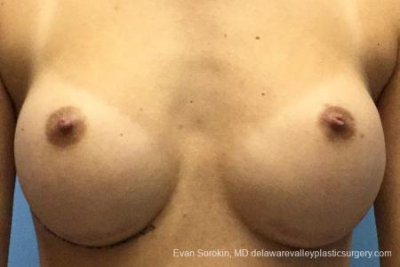 Philadelphia Breast Augmentation 10816 - Before Image 1