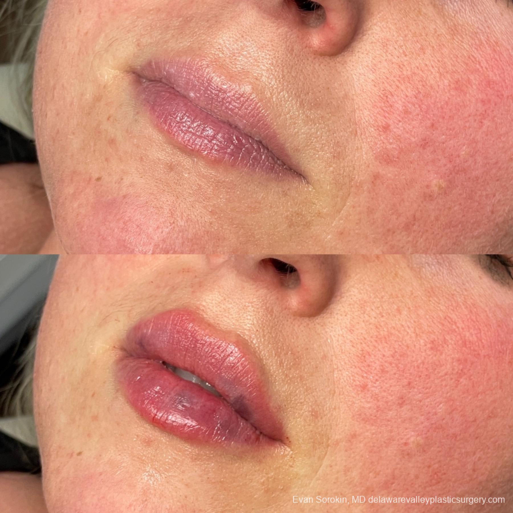 Lip Augmentation: Patient 66 - Before and After 3