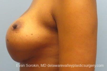 Philadelphia Breast Augmentation 8653 - Before and After Image 4