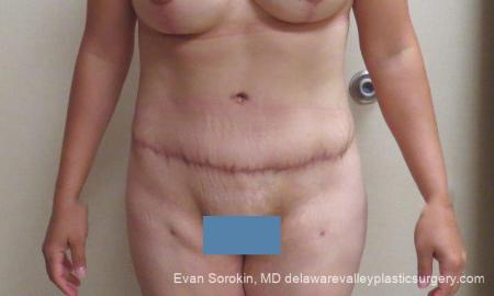 Philadelphia Abdominoplasty 10122 - After Image 1