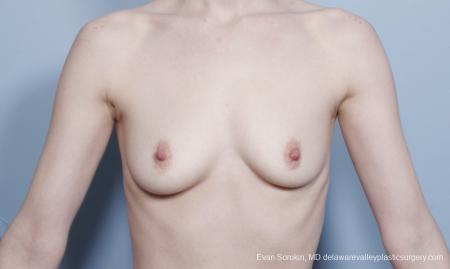 Philadelphia Breast Augmentation 8781 - Before Image 1