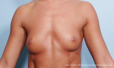 Philadelphia Breast Augmentation 9299 - Before Image 1