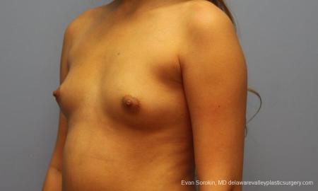 Philadelphia Breast Augmentation 9194 - Before Image 4