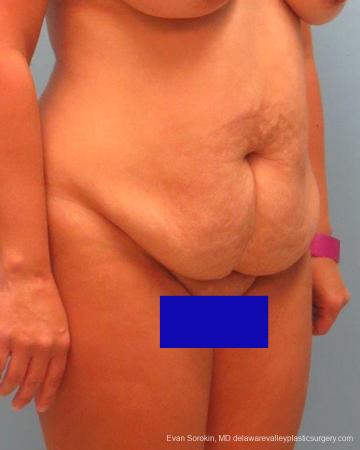 Philadelphia Abdominoplasty 9267 - Before Image 2