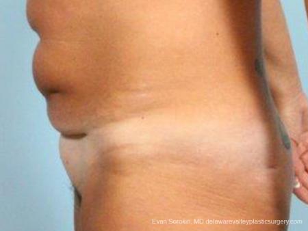 Philadelphia Abdominoplasty 9464 - Before and After Image 5