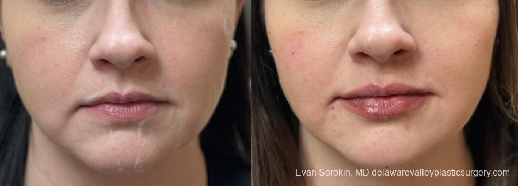 Fillers: Patient 36 - Before and After 