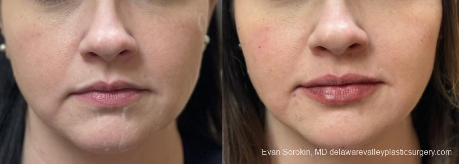 Fillers: Patient 36 - Before and After 1